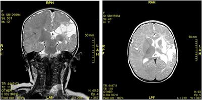 Case Report: Infantile Ischemic Stroke and Antiphospholipid Antibodies, Description of Four Cases